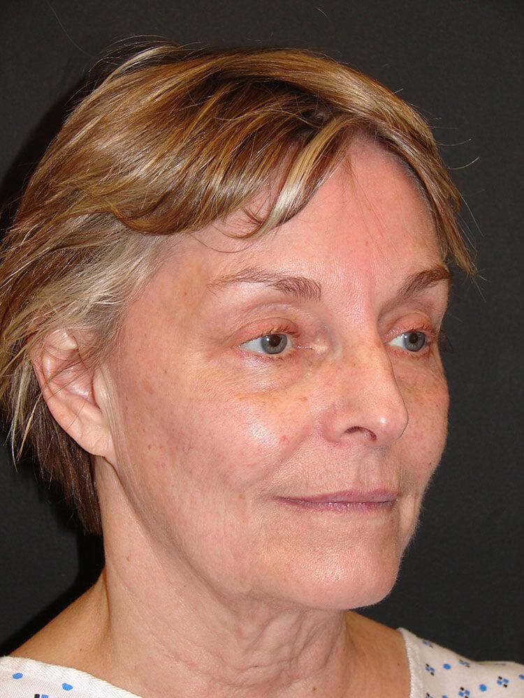 Facelift Before & After Image