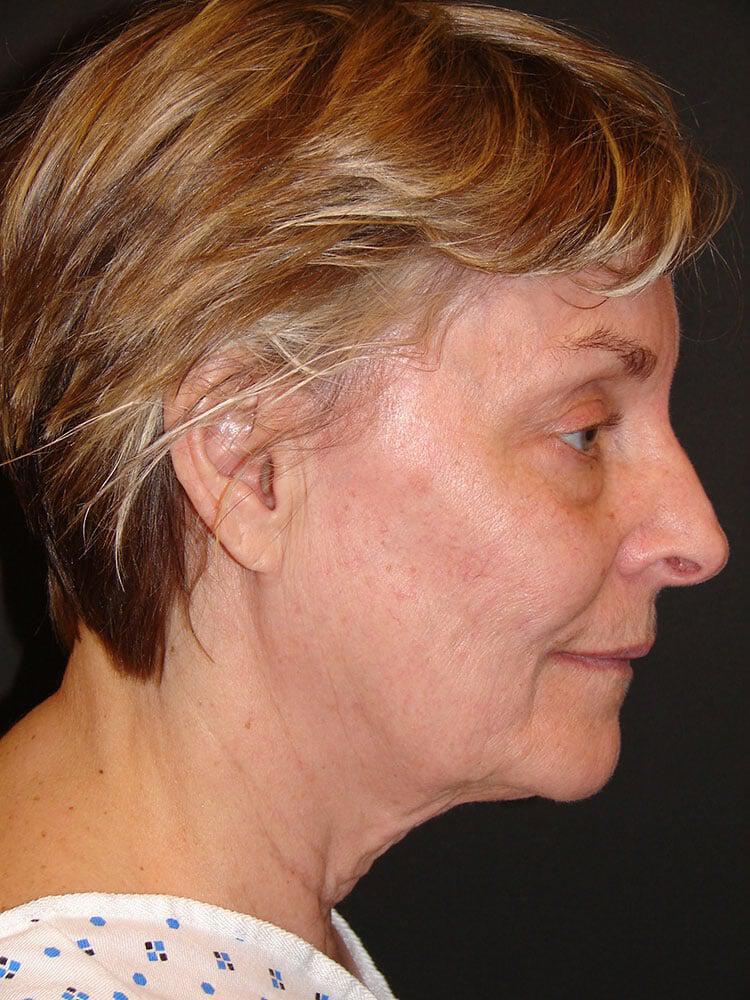 Facelift Before & After Image