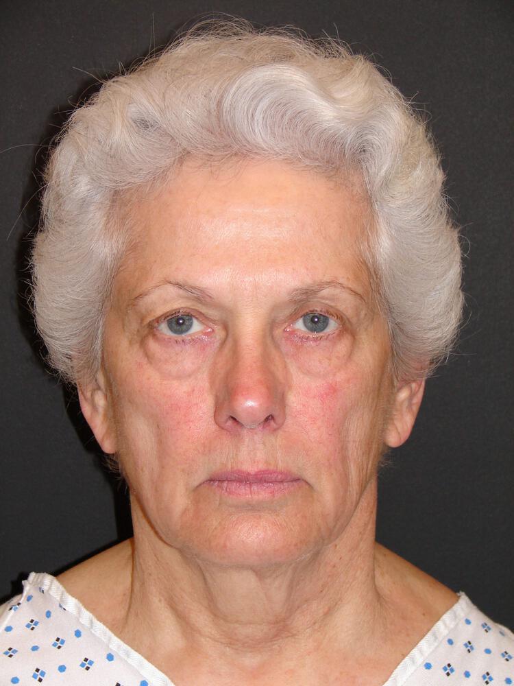 Facelift Before & After Image