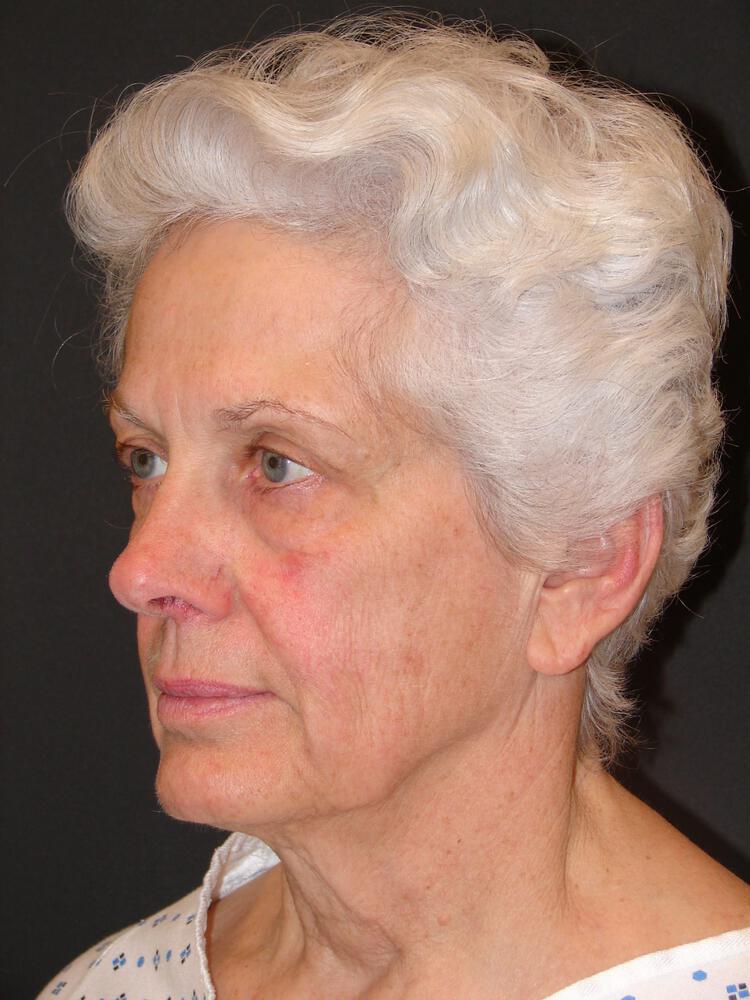 Facelift Before & After Image