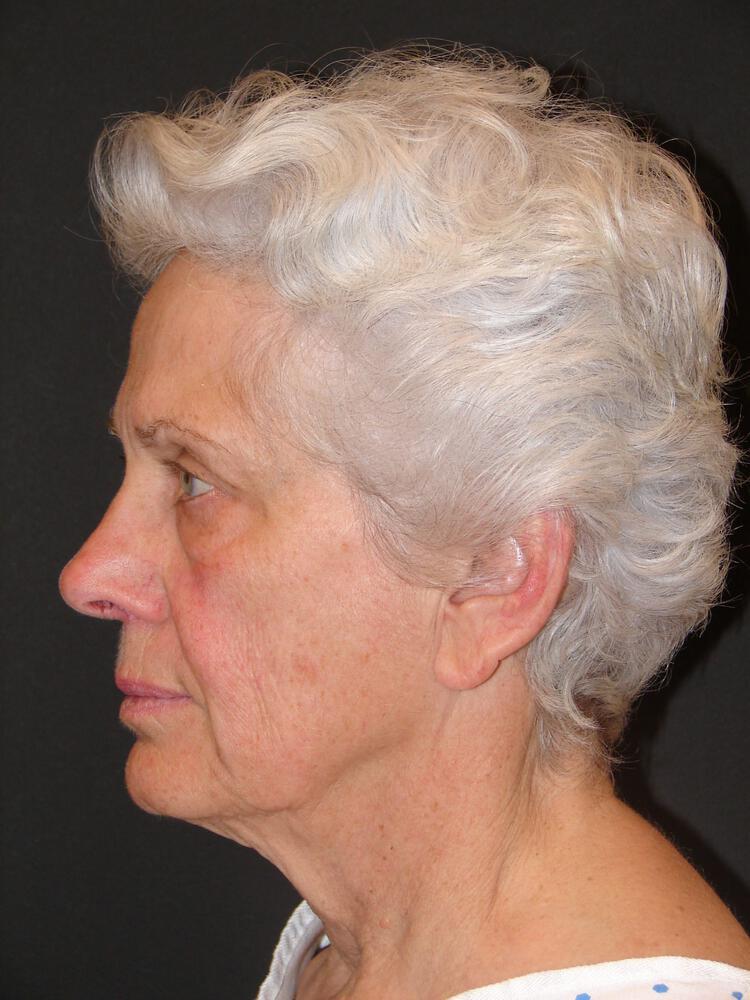 Facelift Before & After Image