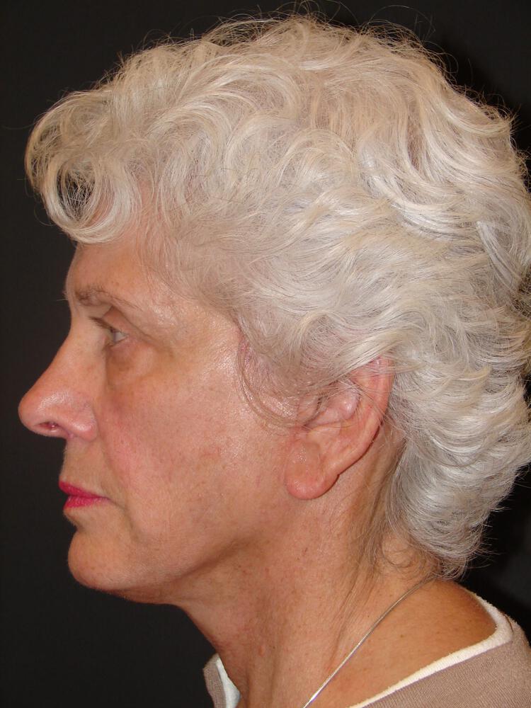 Facelift Before & After Image