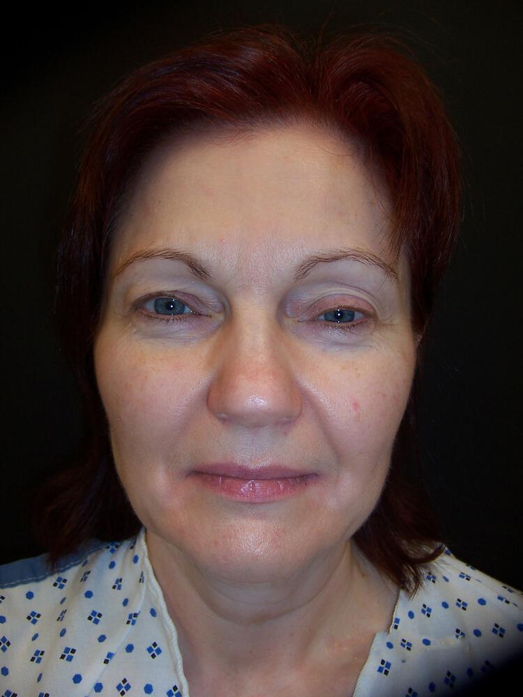 Facelift Before & After Image