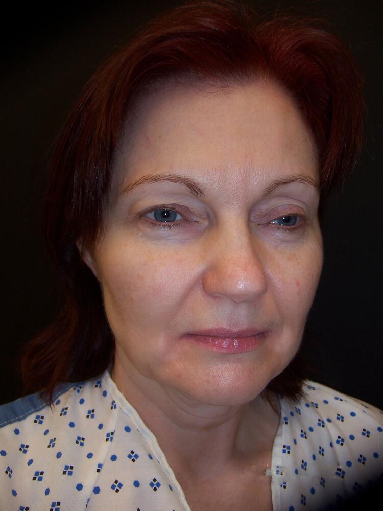 Facelift Before & After Image