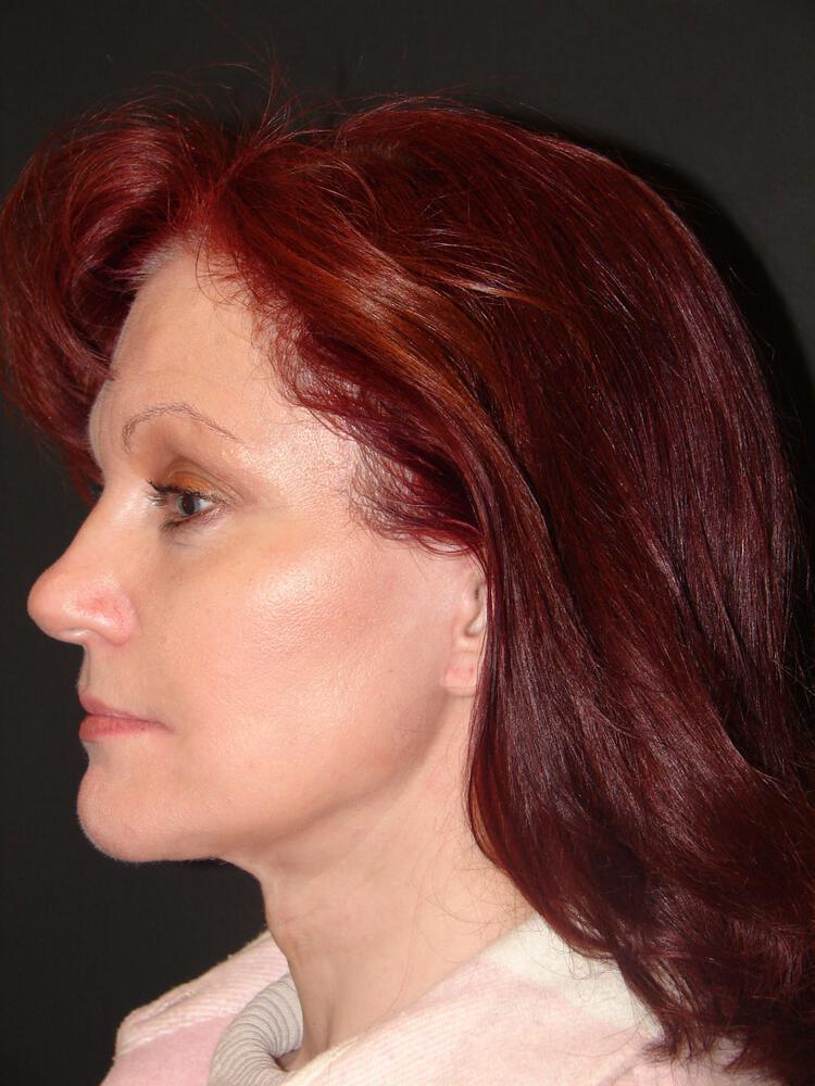 Facelift Before & After Image