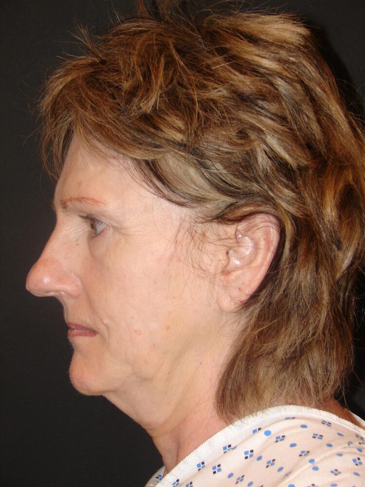 Facelift Before & After Image