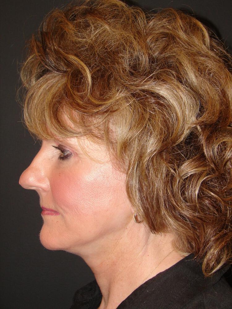 Facelift Before & After Image