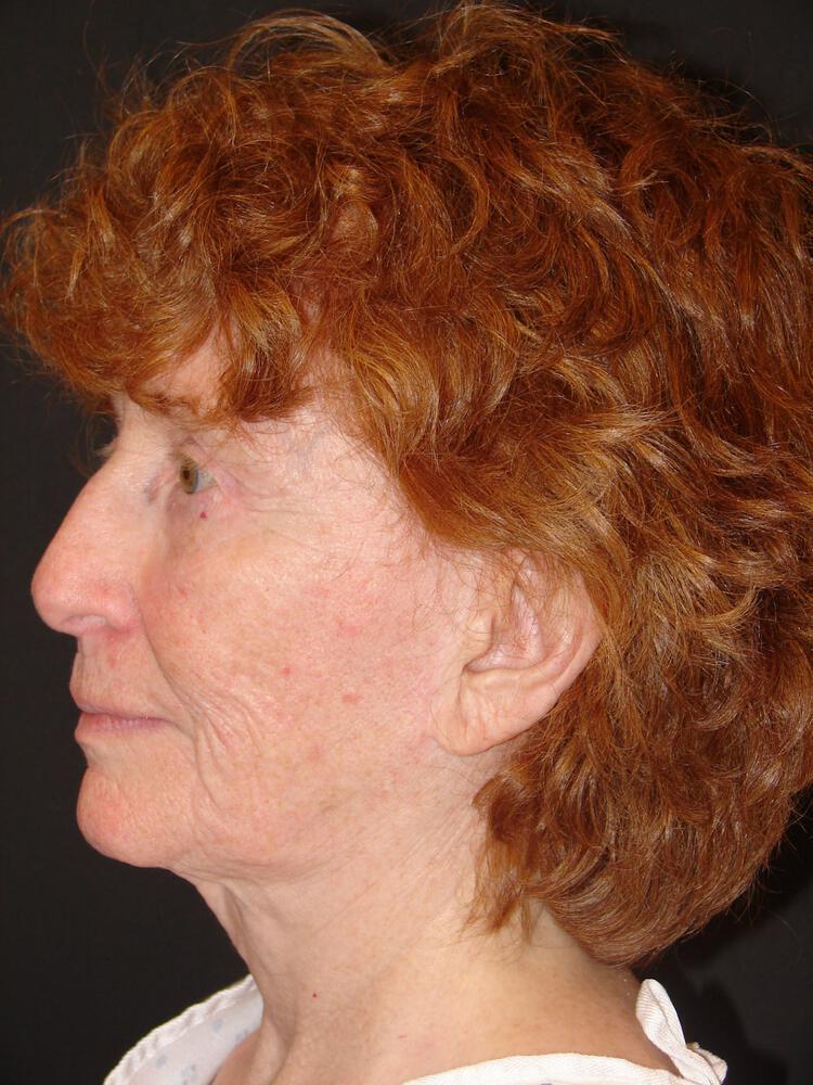 Facelift Before & After Image