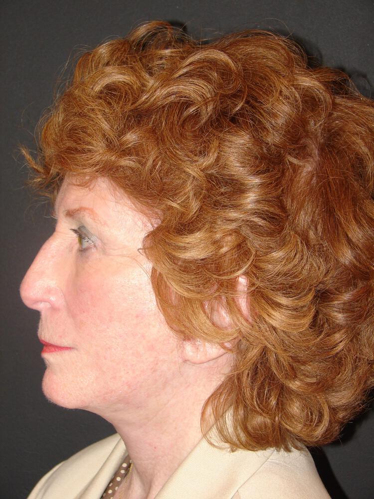 Facelift Before & After Image