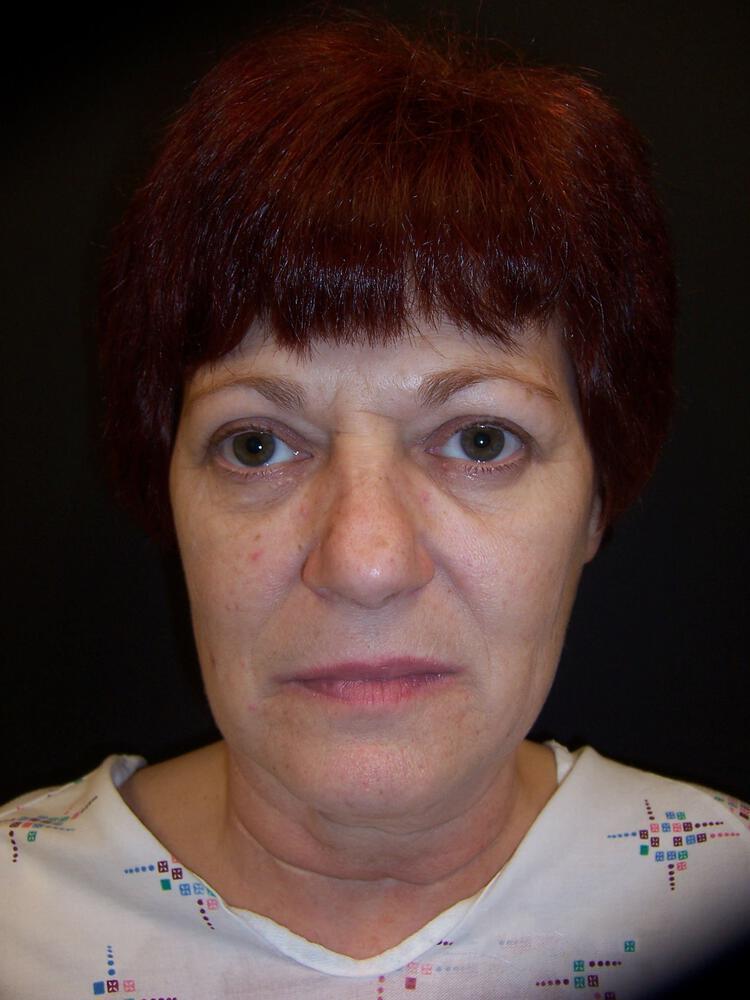 Facelift Before & After Image