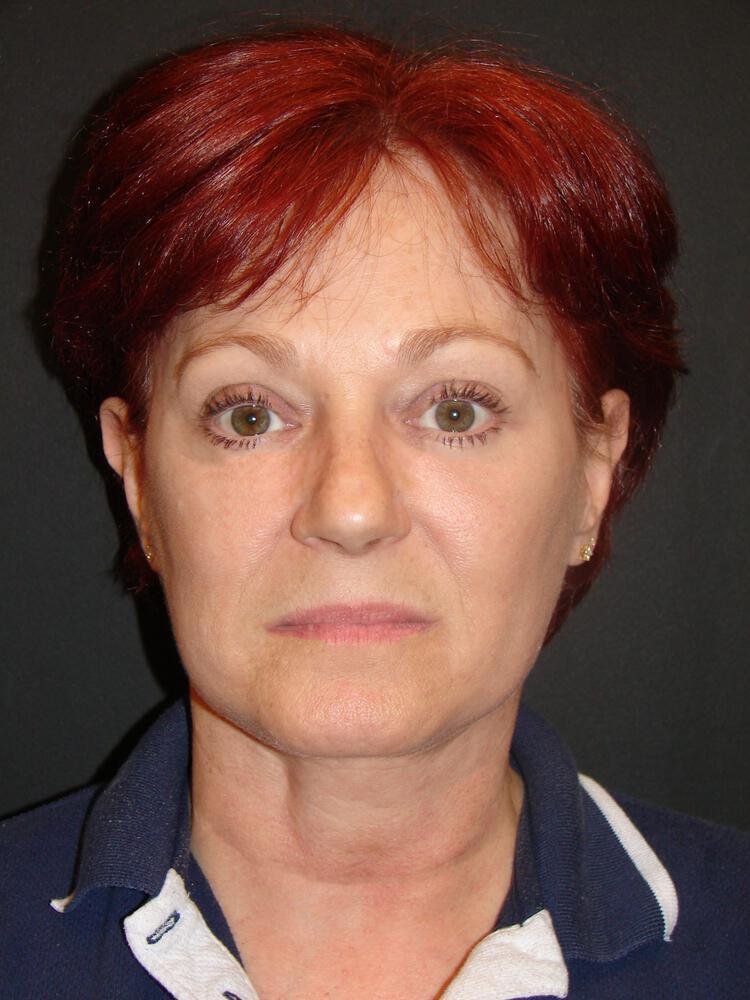 Facelift Before & After Image