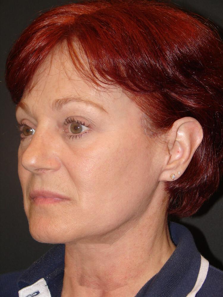 Facelift Before & After Image