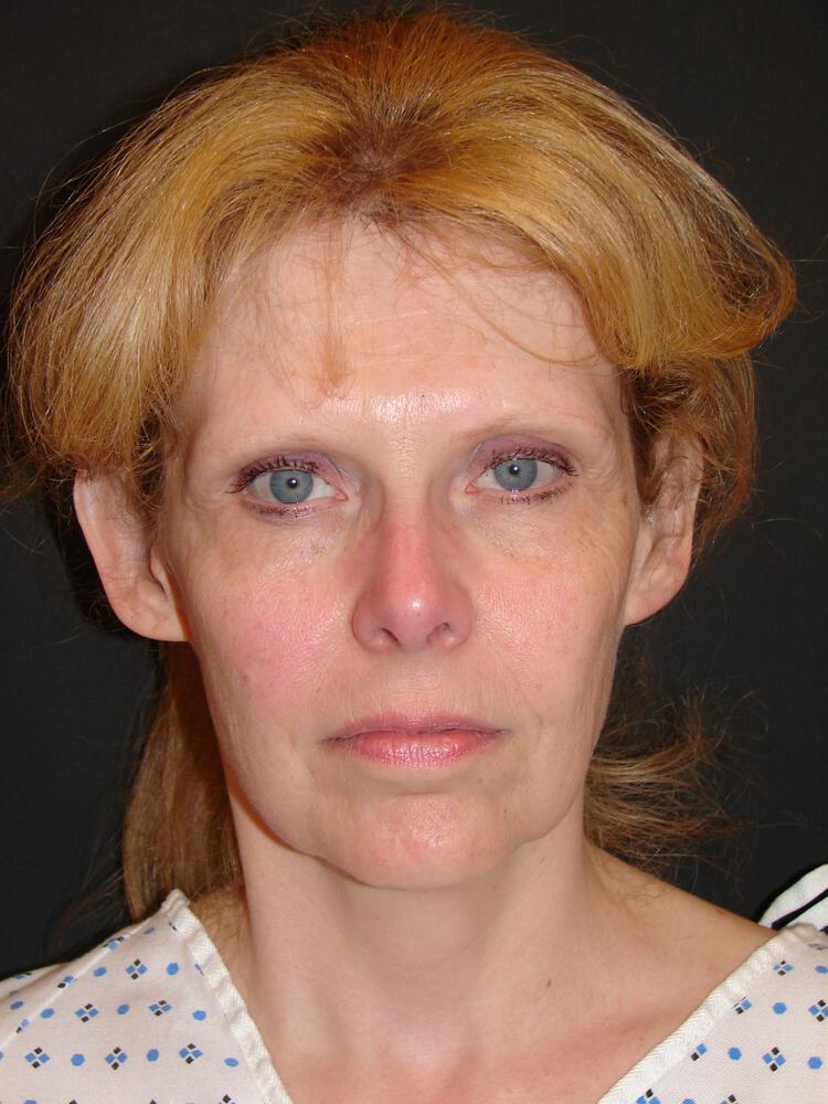 Facelift Before & After Image