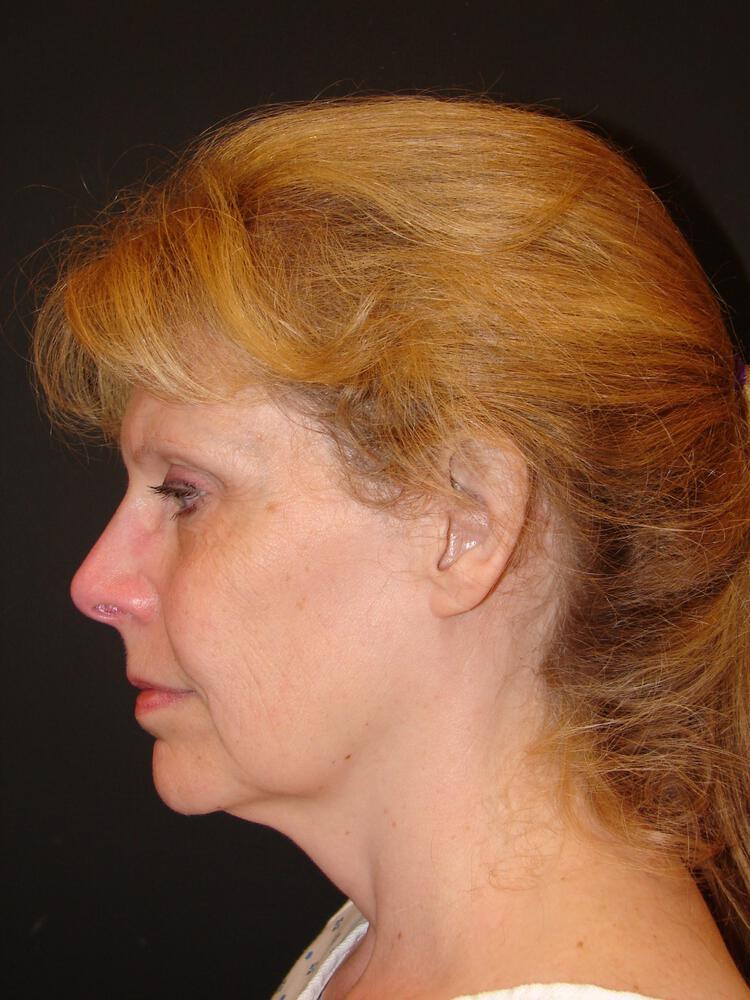 Facelift Before & After Image