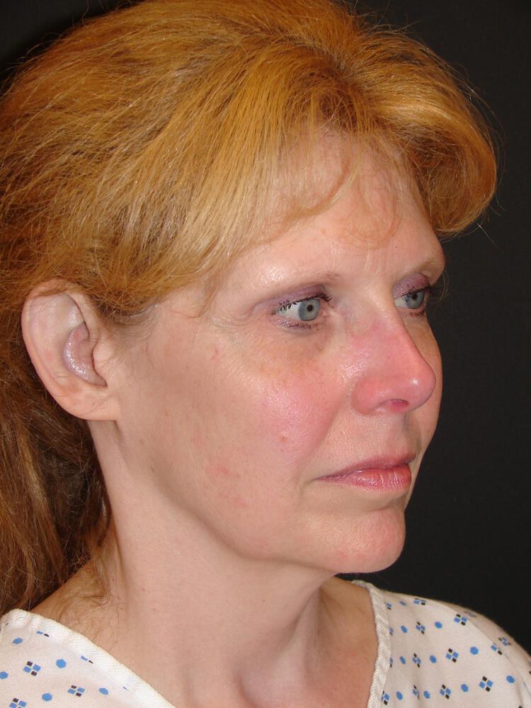 Facelift Before & After Image