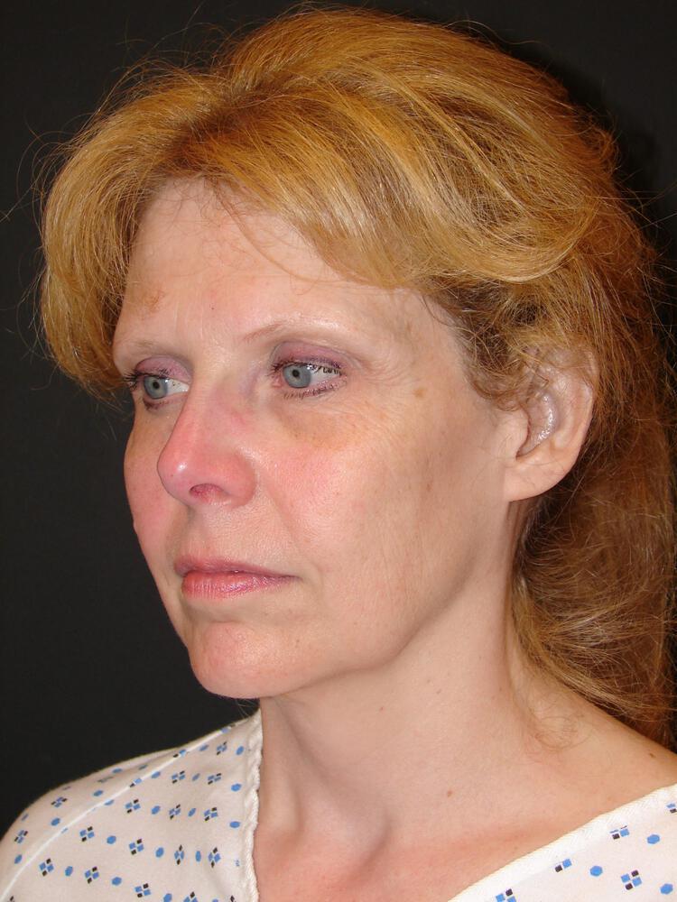 Facelift Before & After Image