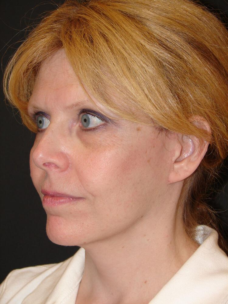 Facelift Before & After Image