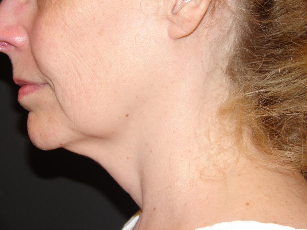 Facelift Before & After Image
