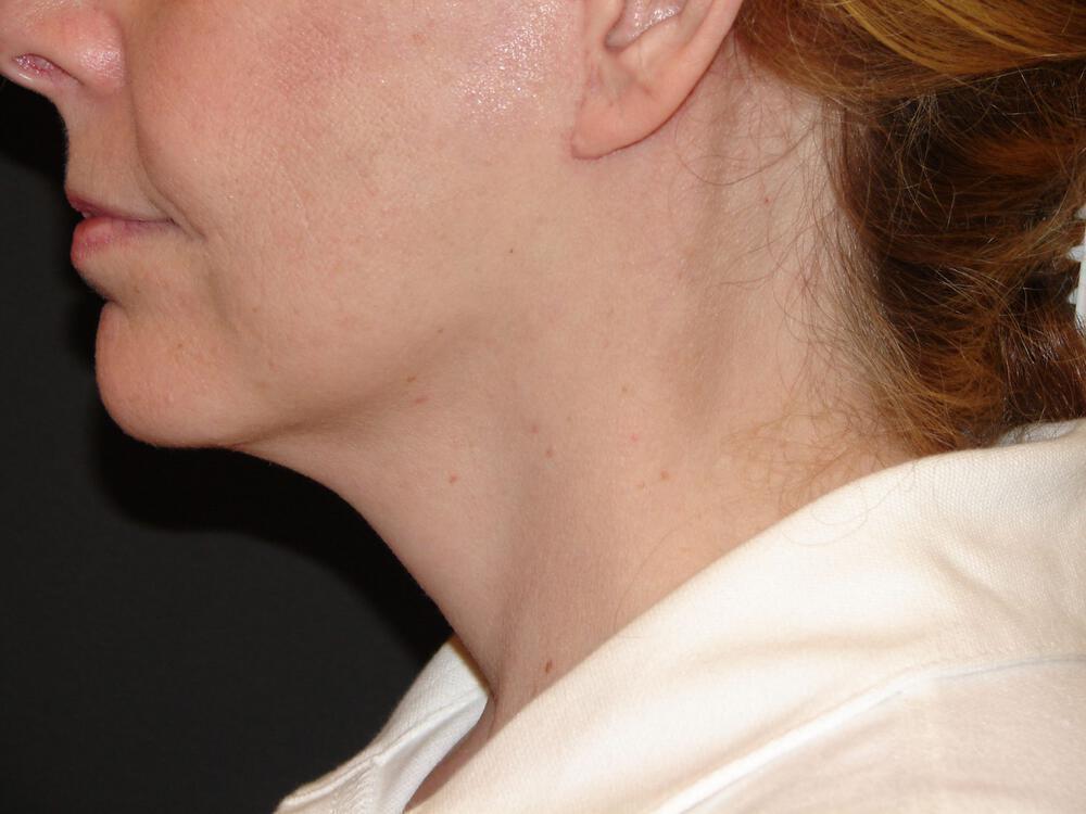 Facelift Before & After Image