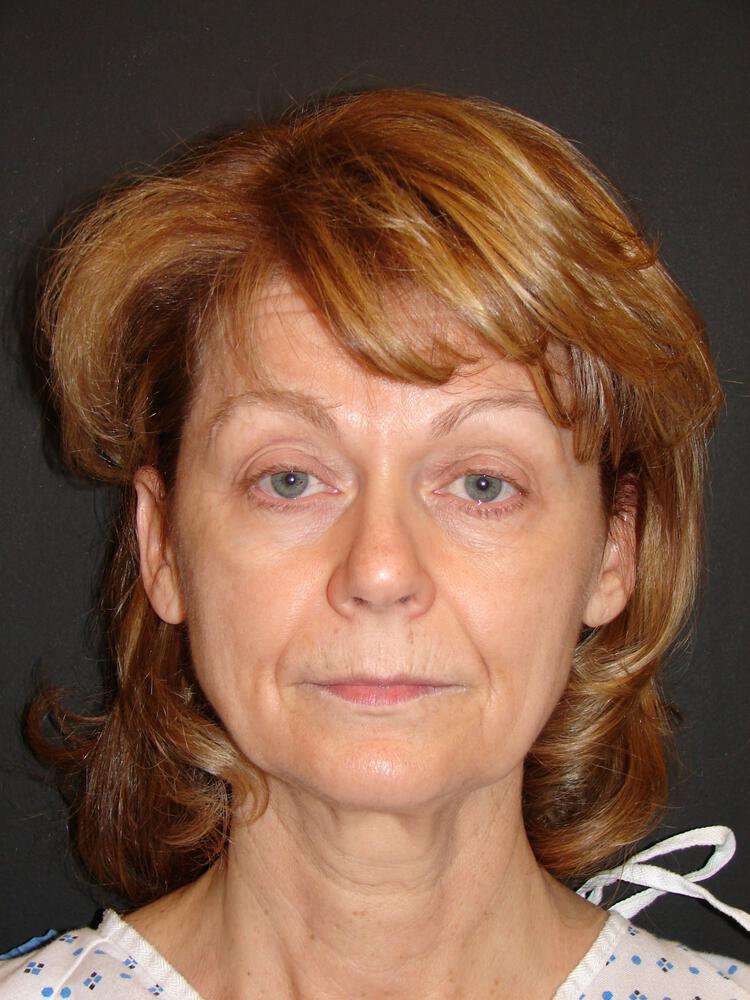 Facelift Before & After Image