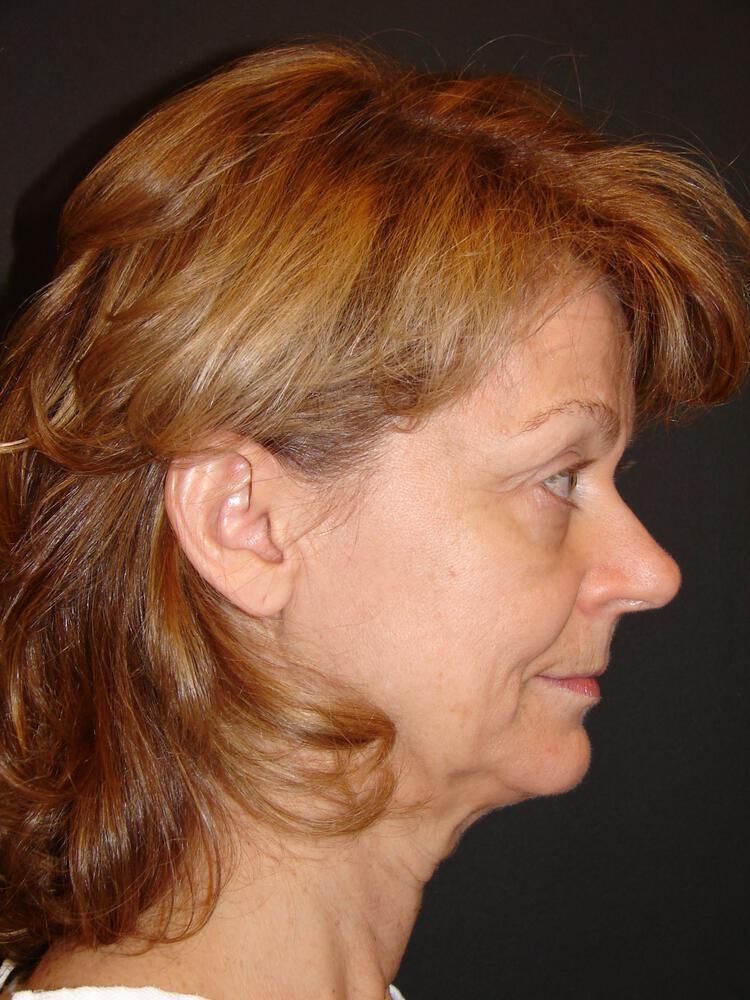 Facelift Before & After Image