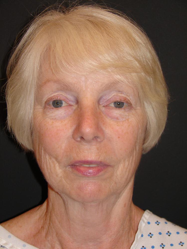 Facelift Before & After Image