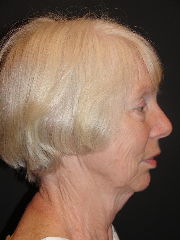 Facelift Before & After Image