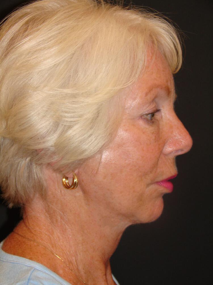 Facelift Before & After Image