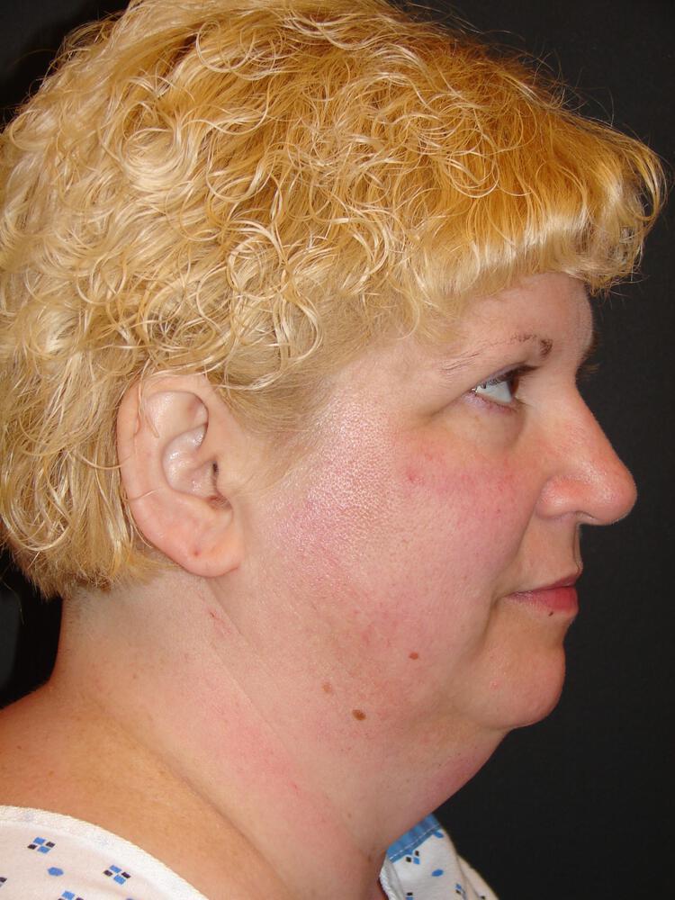 Facelift Before & After Image