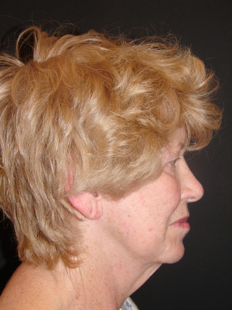 Facelift Before & After Image