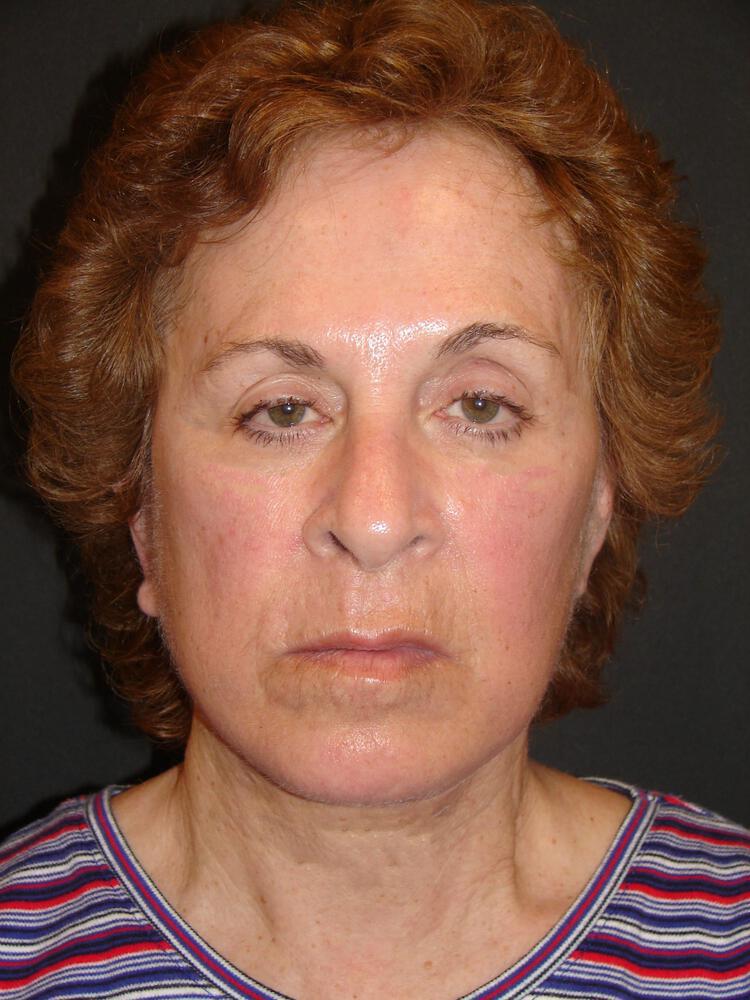 Facelift Before & After Image