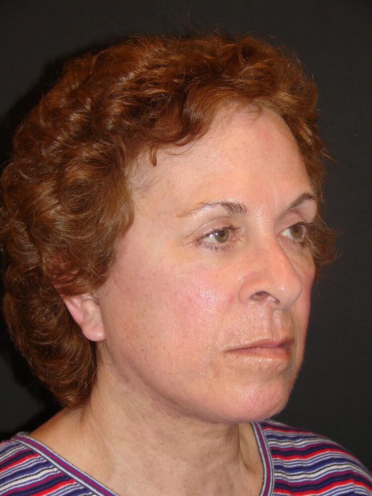 Facelift Before & After Image