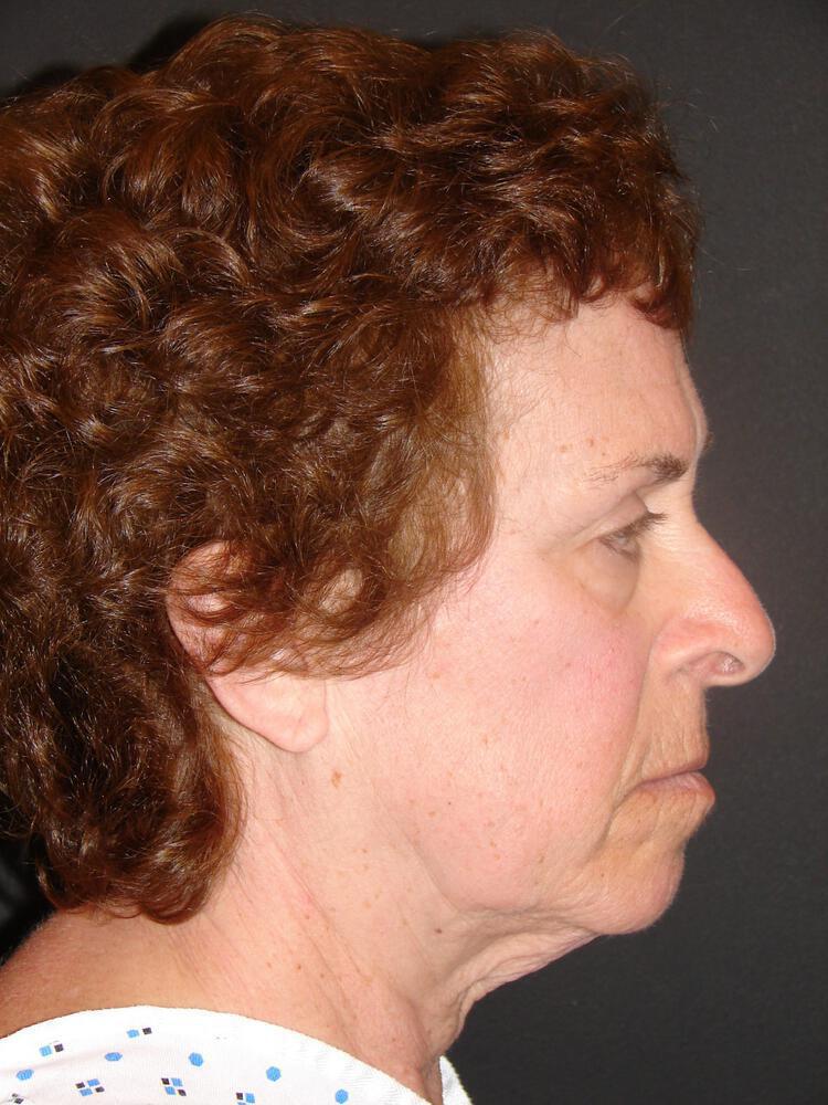 Facelift Before & After Image