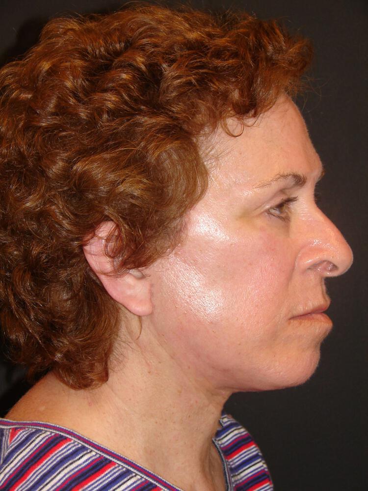 Facelift Before & After Image