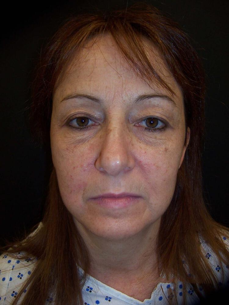 Facelift Before & After Image