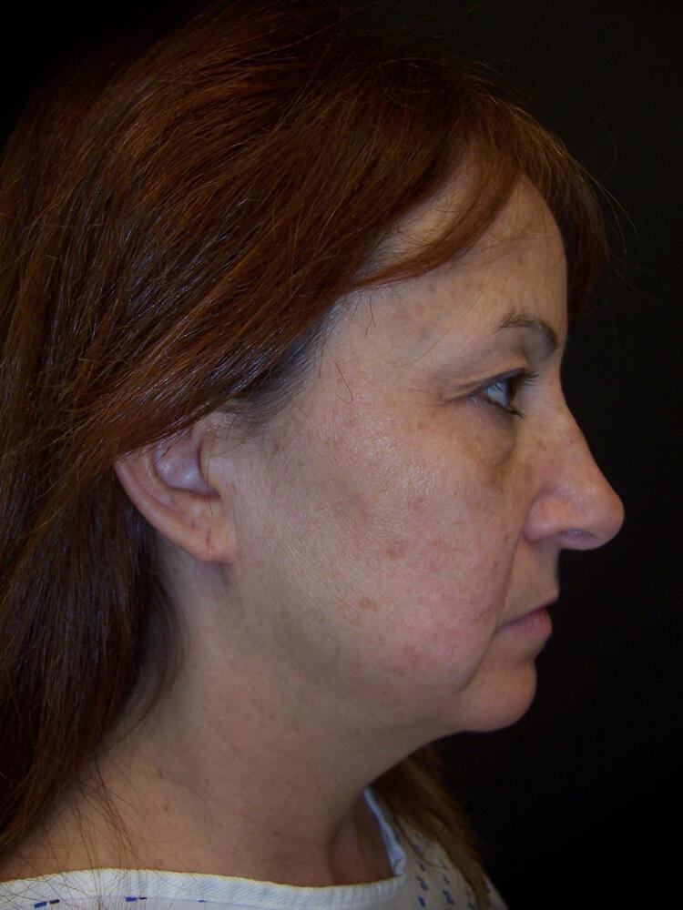 Facelift Before & After Image