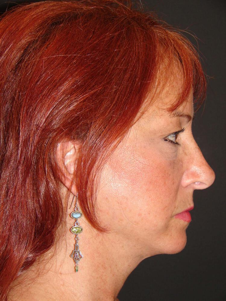 Facelift Before & After Image