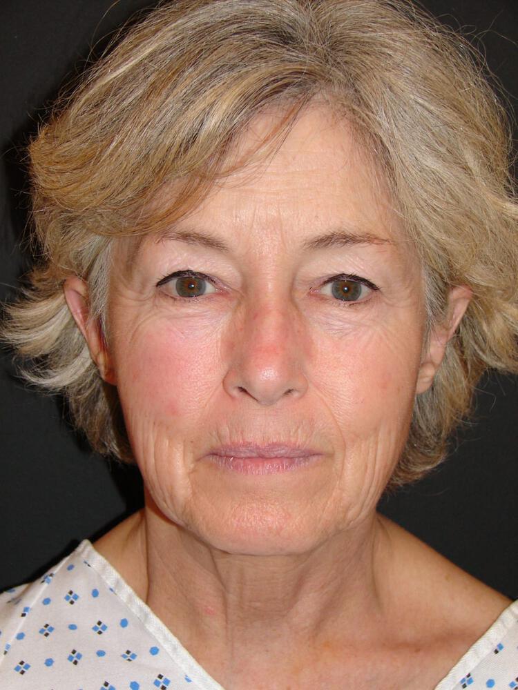 Facelift Before & After Image