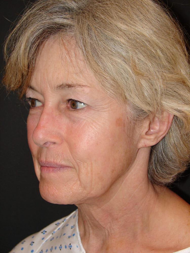 Facelift Before & After Image