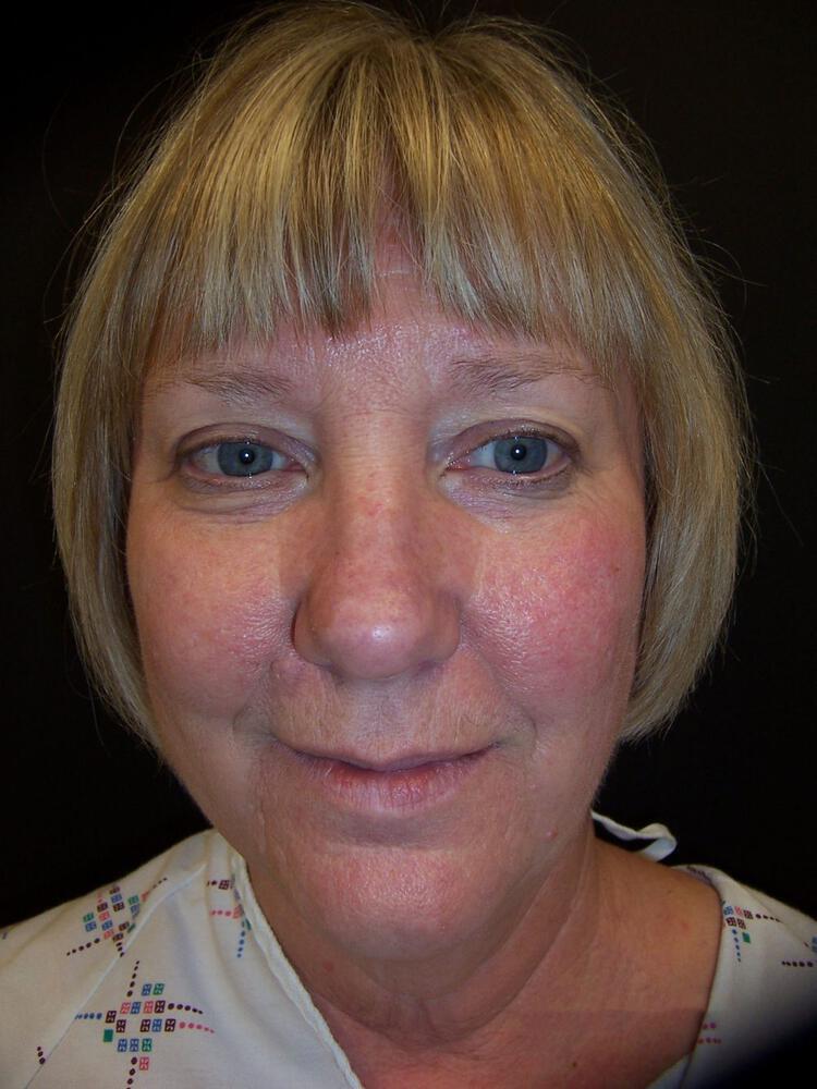 Facelift Before & After Image