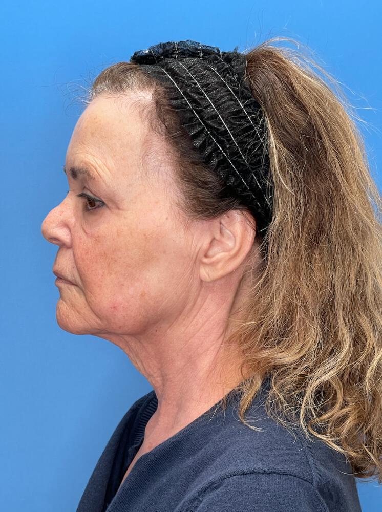 Facelift Before & After Image