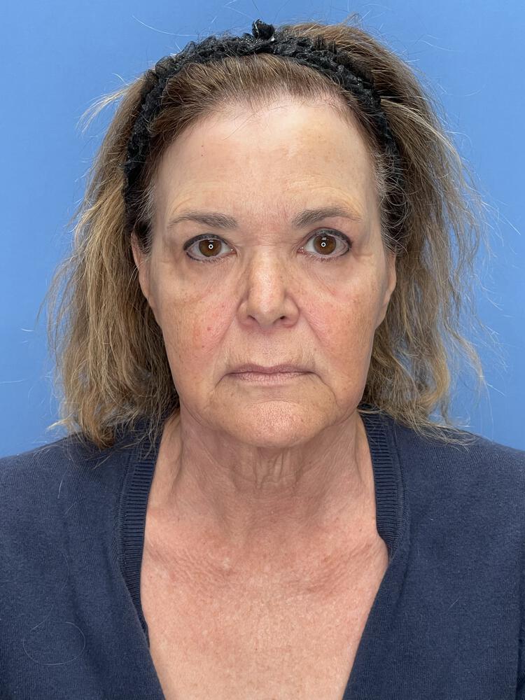 Facelift Before & After Image