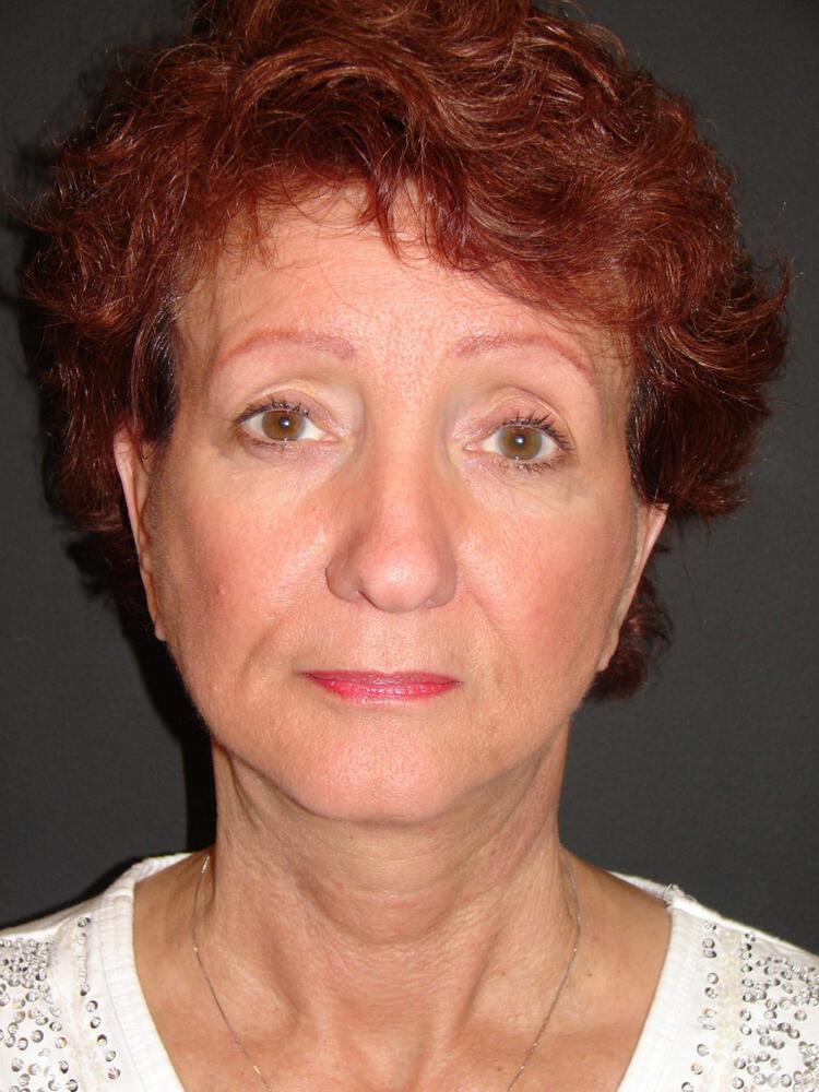 Facelift Before & After Image