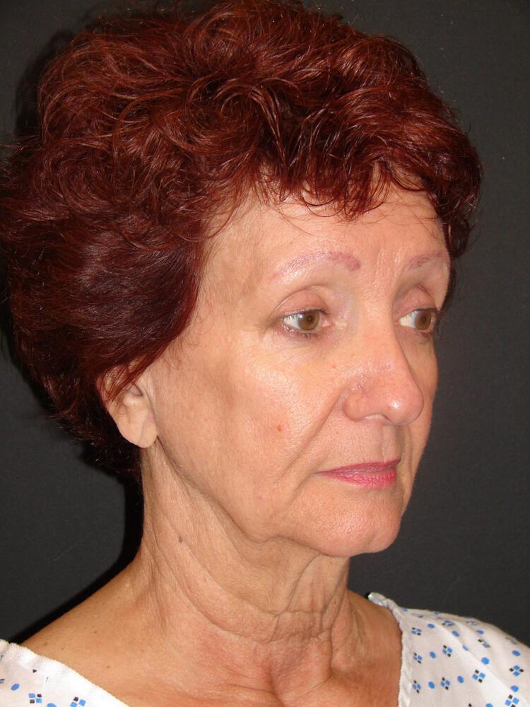 Facelift Before & After Image