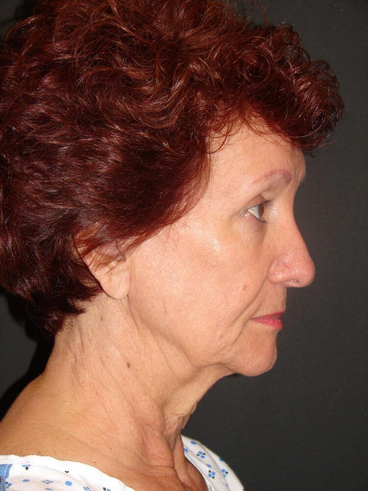 Facelift Before & After Image