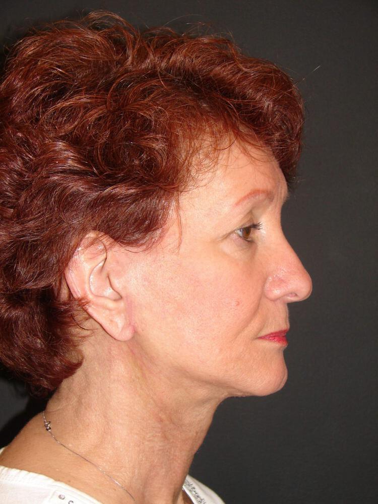 Facelift Before & After Image