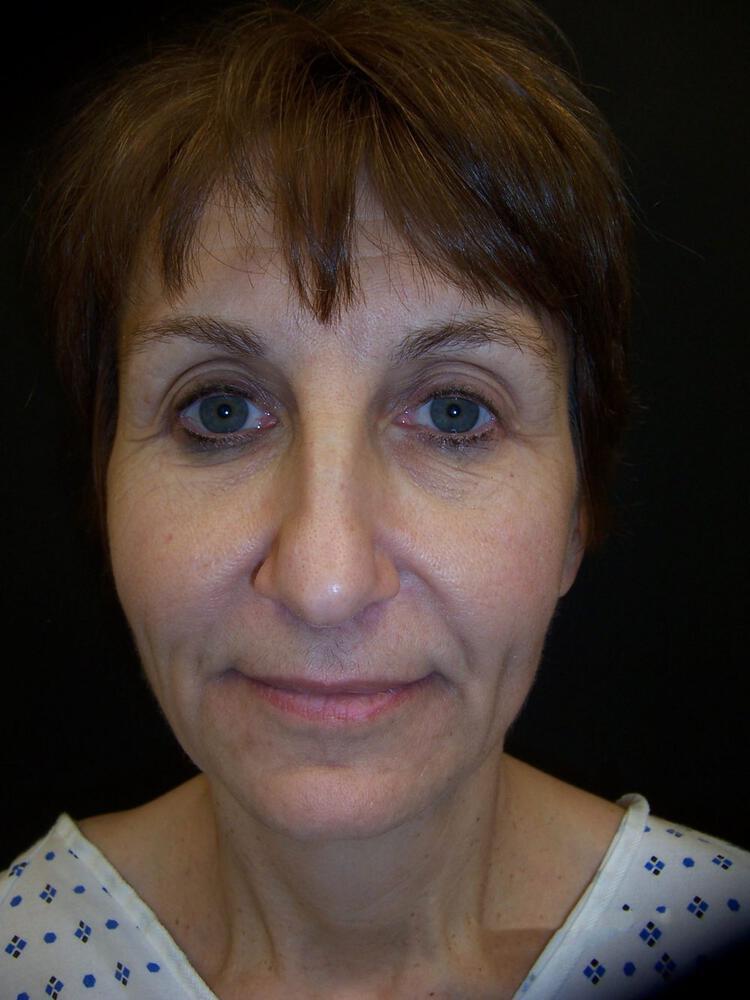 Facelift Before & After Image