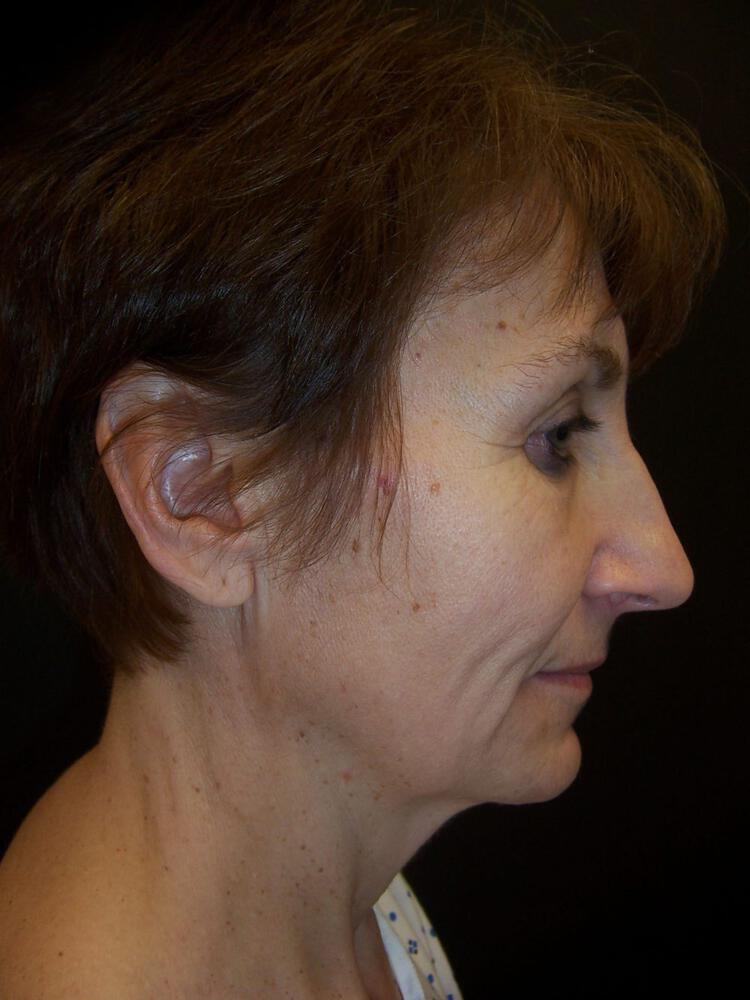 Facelift Before & After Image