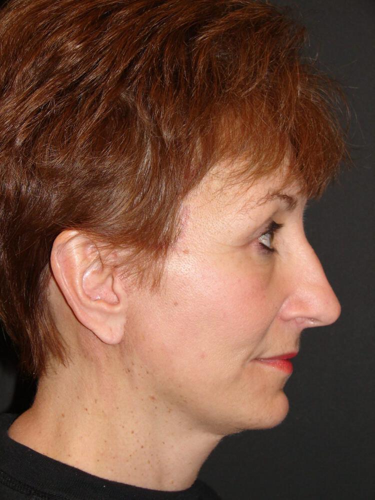 Facelift Before & After Image