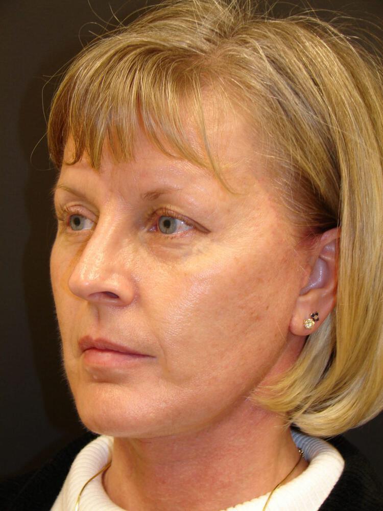 Facelift Before & After Image